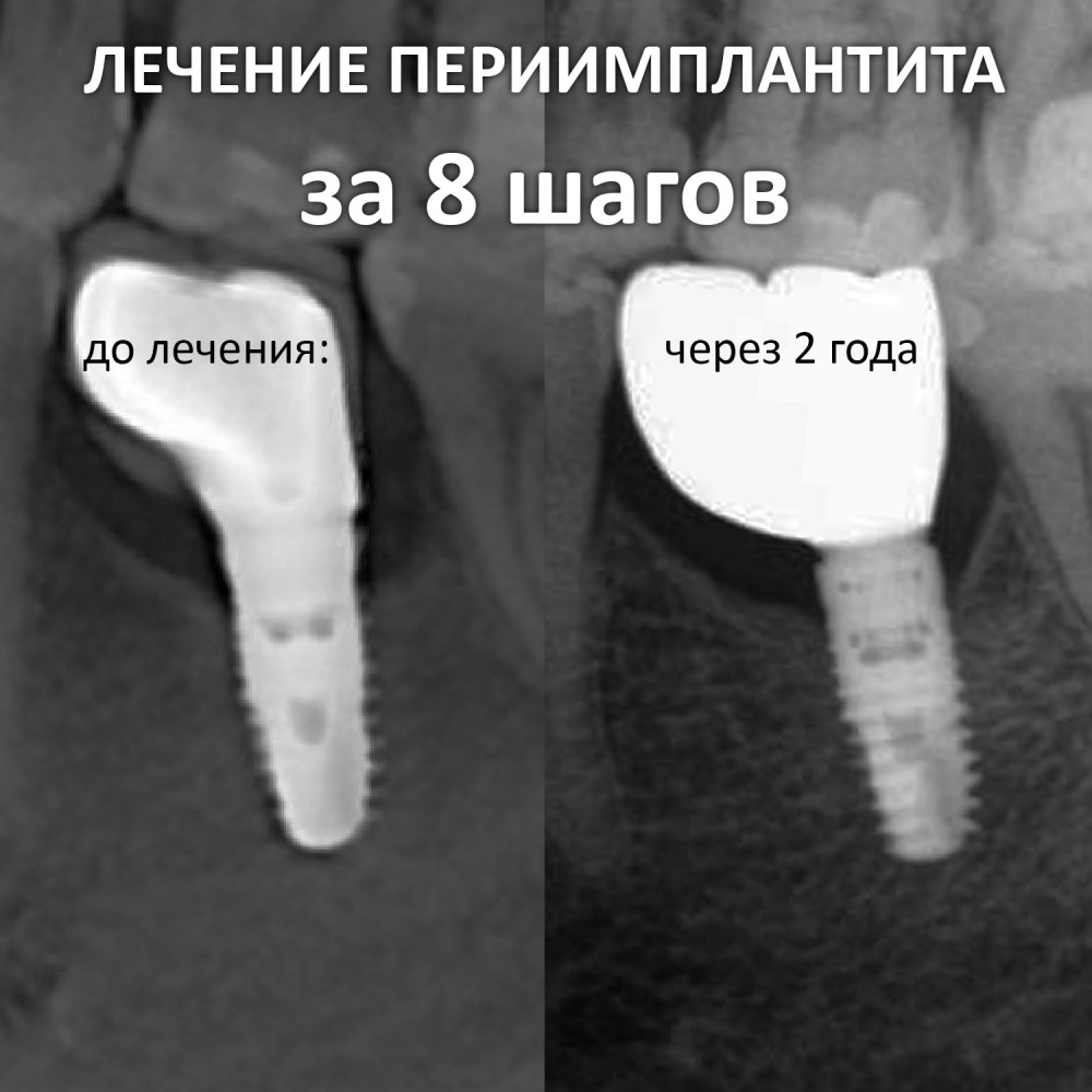Лечение периимплантита за 8 шагов