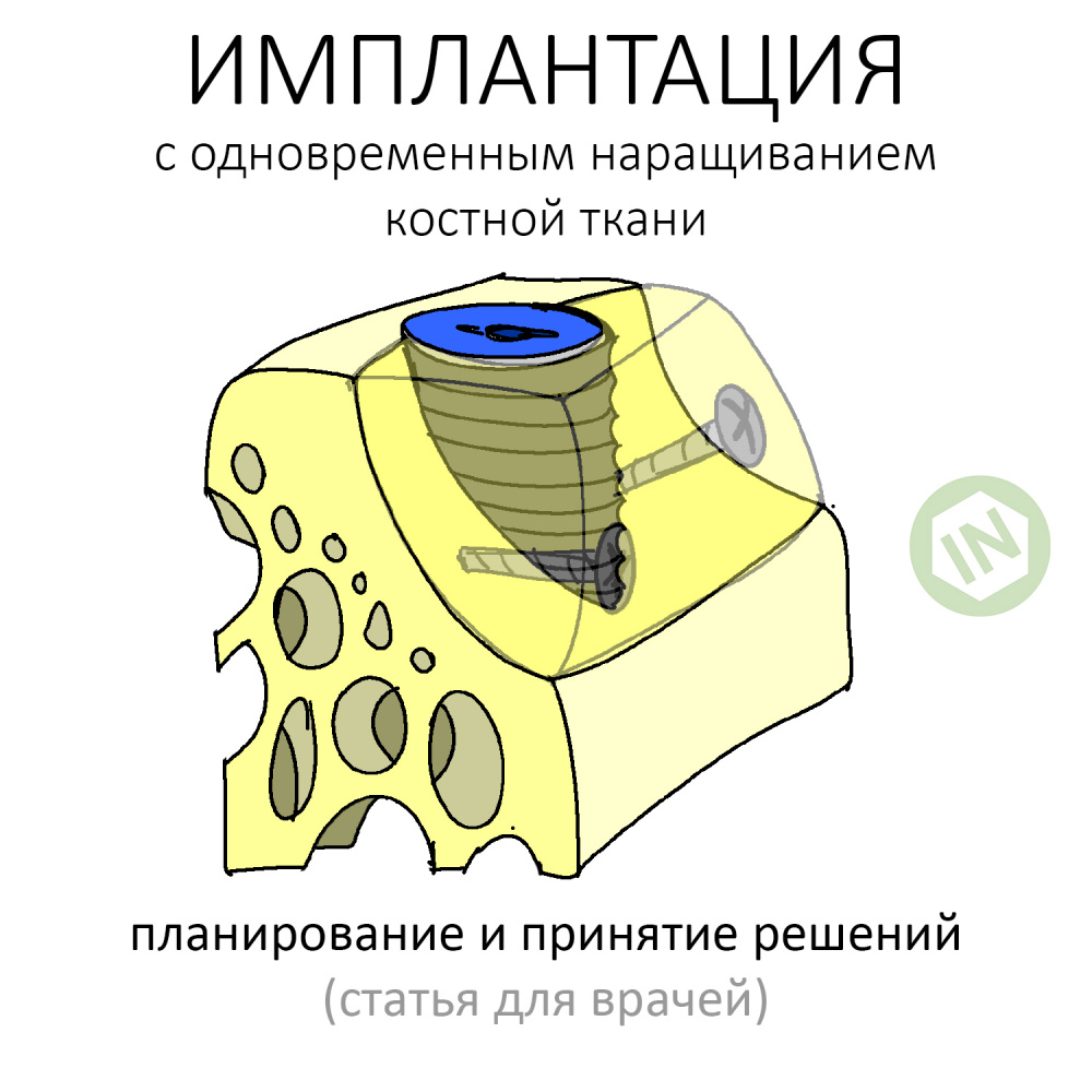 Имплантация с одновременным наращиванием костной ткани. Планирование и принятие решений.