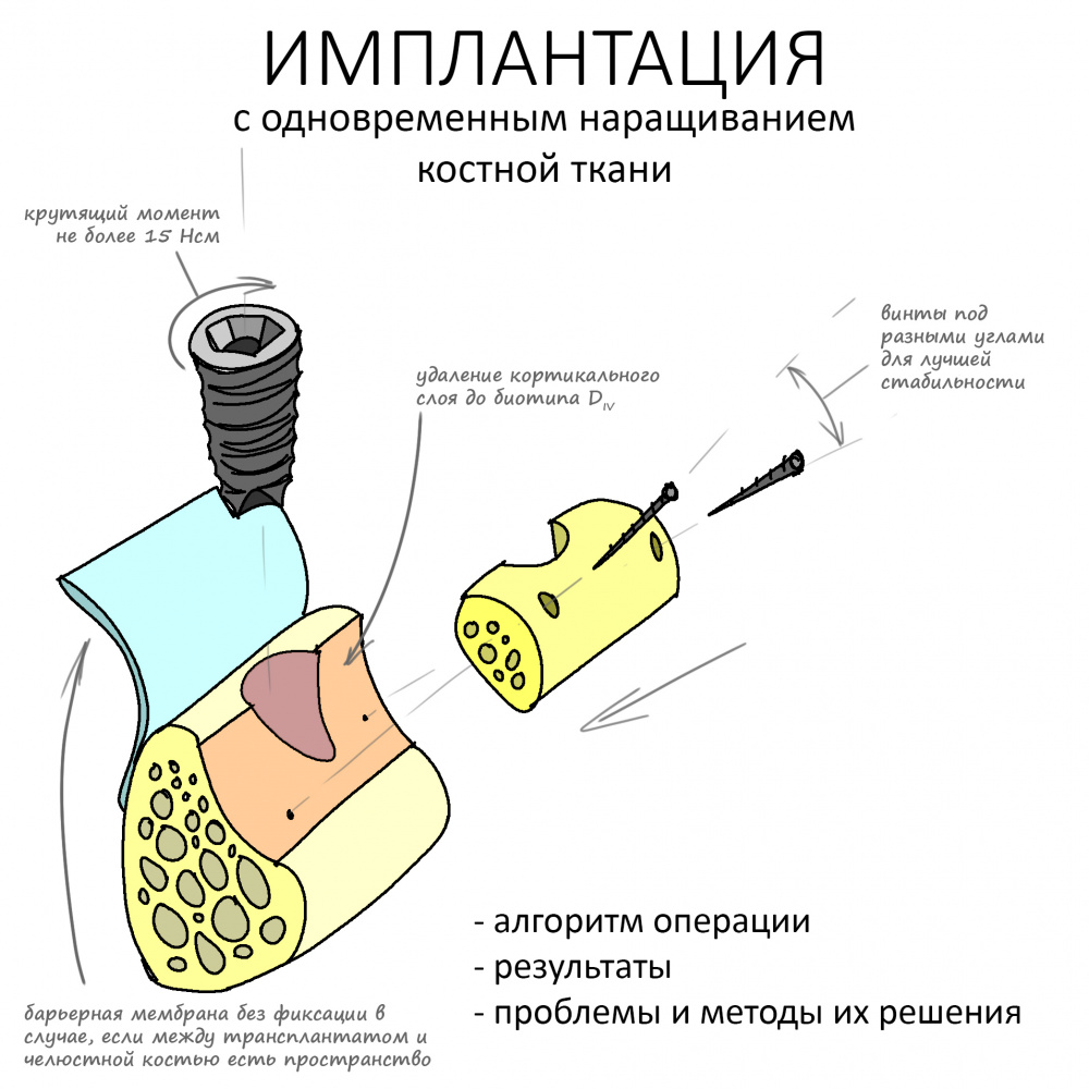 Имплантация с одновременным наращиванием костной ткани. Алгоритм операции, результаты, проблемы и методы их решения.