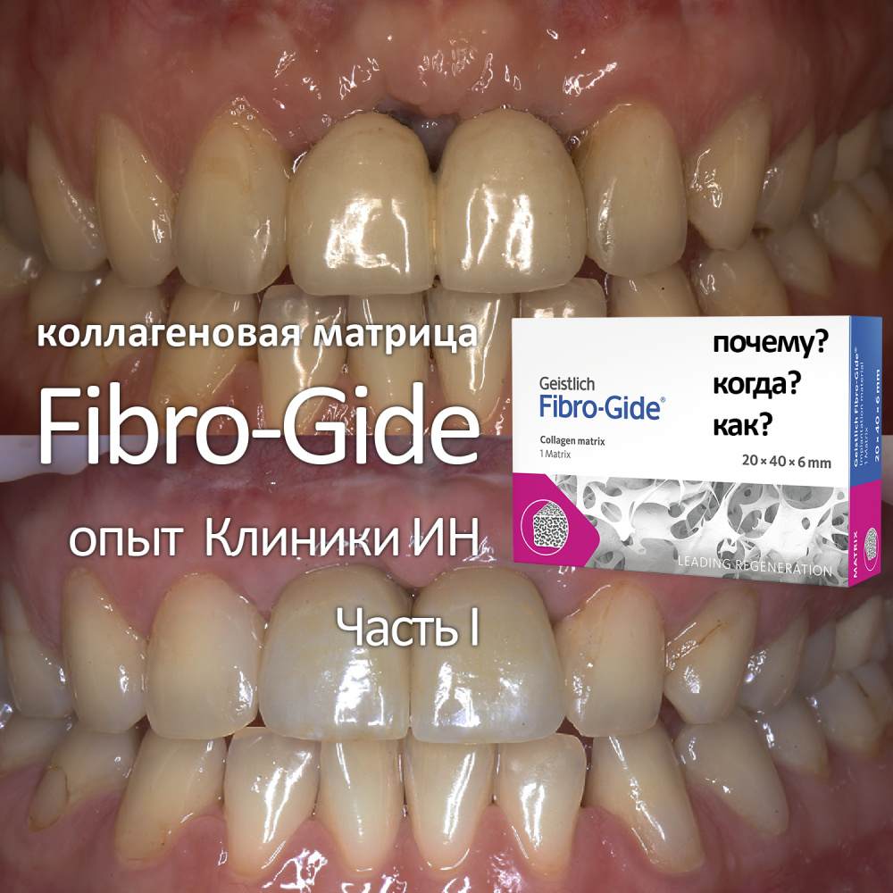 Коллагеновая матрица Fibro-Gide: почему, когда и как? Опыт Клиники ИН, Часть I.