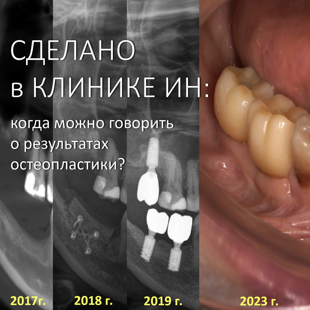СДЕЛАНО В КЛИНИКЕ ИН: когда можно говорить о результатах остеопластики?